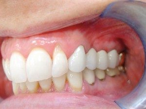 mini dental implants Hartland, WI